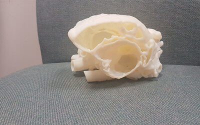 3D Heart Printer already making a difference!