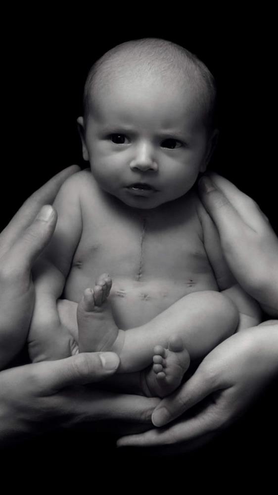 Black and white portrait of Arthur as a baby showing his heart surgery scar on his chest