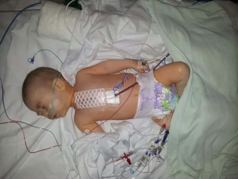 Baby william in a hospital bed, lots of tubes and wires after open heart surgery with a waffle plaster down the middle of his chest