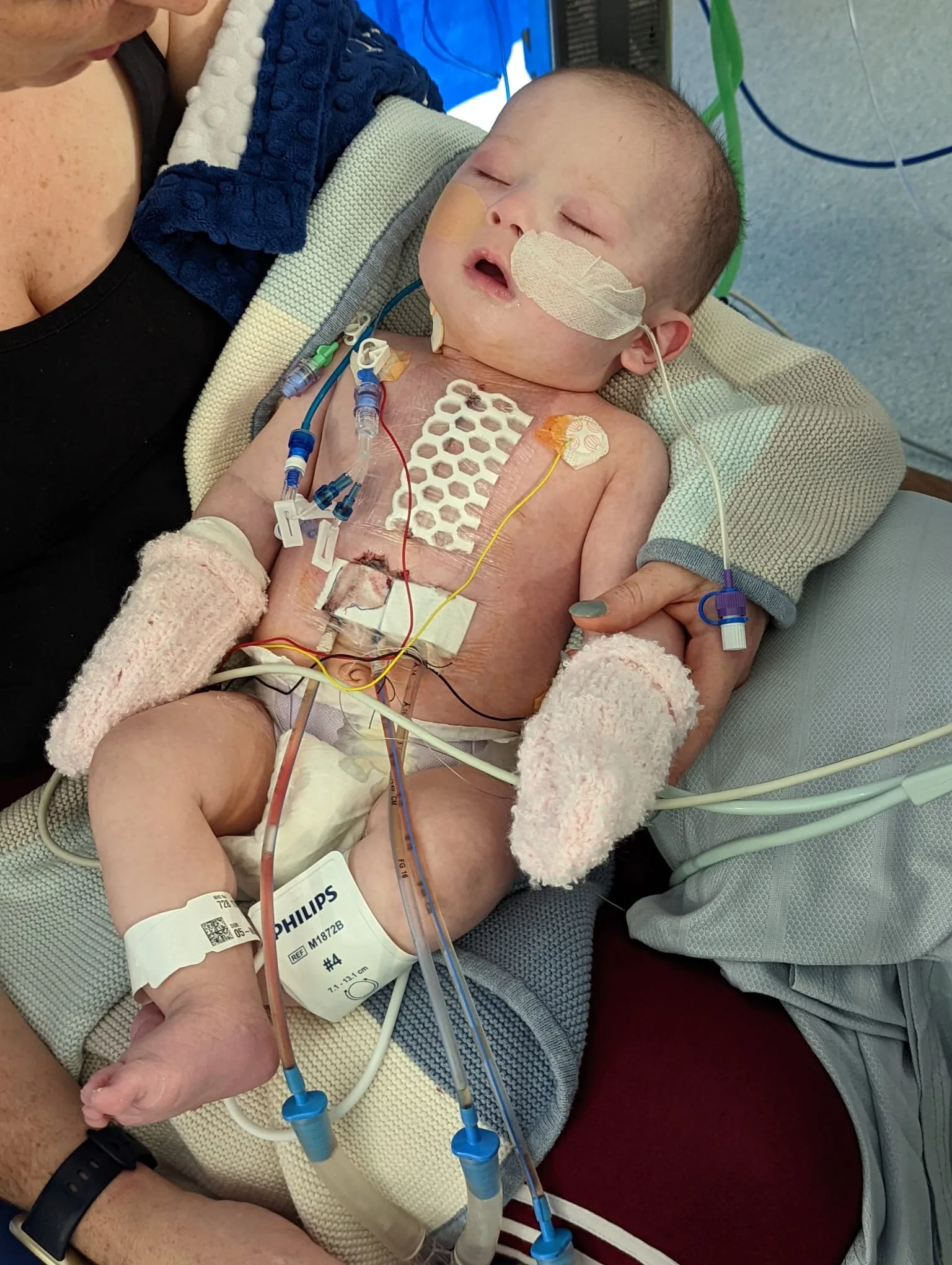 Lochie as a baby asleep asfter his open heart surgery with lots of tubes, wires and a waffle plaster on his chest covering his open heart surgery scar
