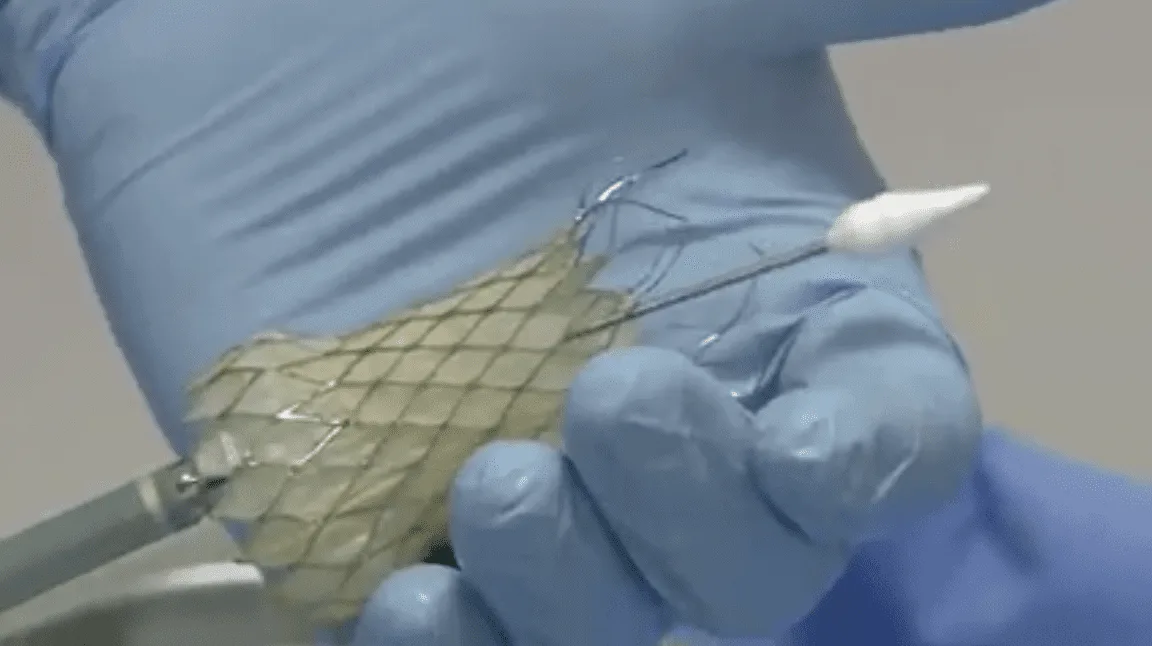 Revolutionary valve procedure performed in Leeds